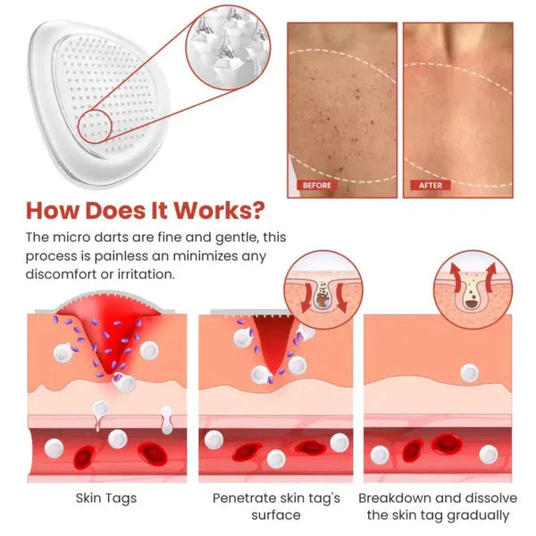 Derma Smooth Skin Tag Removal Patch -